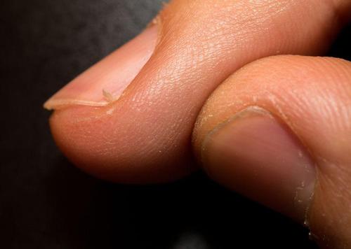 さかむけはどうしてできる？原因から予防法や治し方まで解説